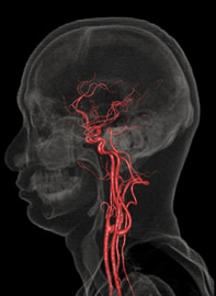 頭頚部血管撮像
